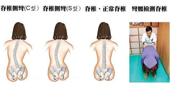脊柱侧凸预防需趁早