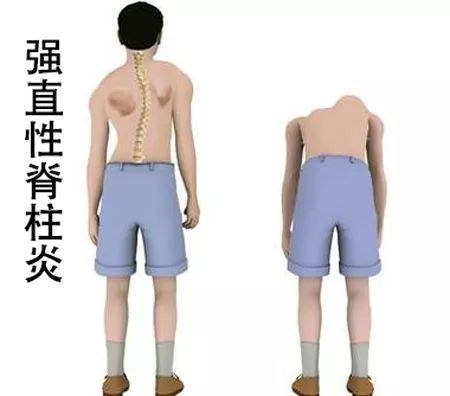 强直护理