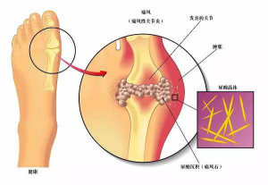 成都痛风医院